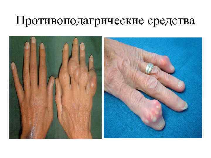 Противоподагрические средства 