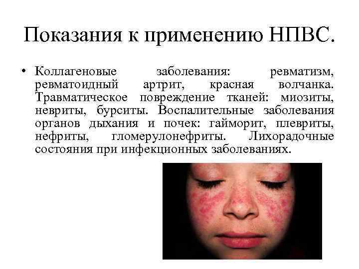 Показания к применению НПВС.  • Коллагеновые  заболевания: ревматизм,  ревматоидный артрит, 