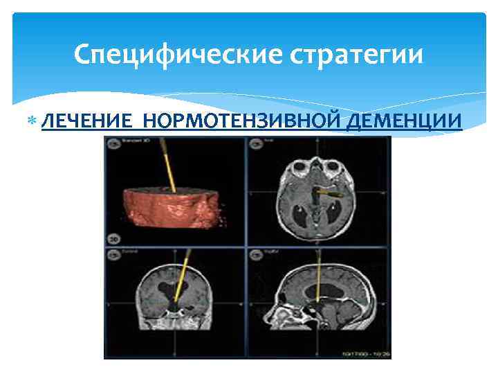   Специфические стратегии  ЛЕЧЕНИЕ НОРМОТЕНЗИВНОЙ ДЕМЕНЦИИ 