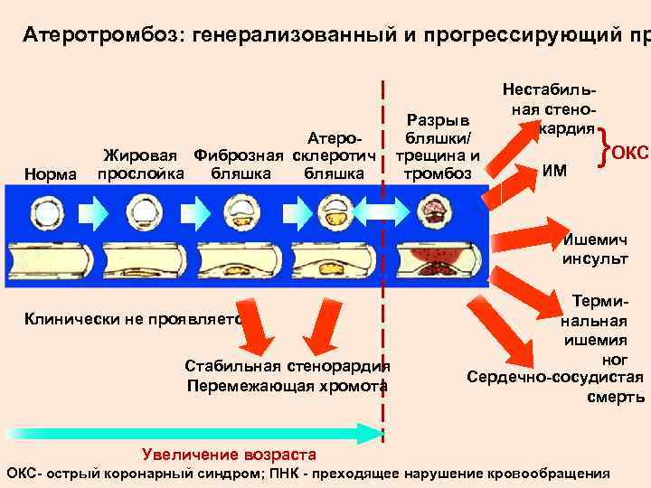  Атеротромбоз: генерализованный и прогрессирующий пр      Нестабиль-  