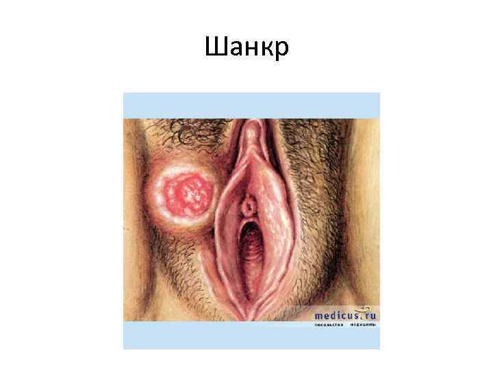 Шанкр Шанкр