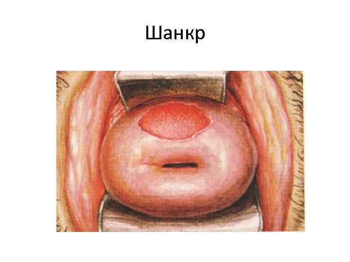 Шанкр Шанкр