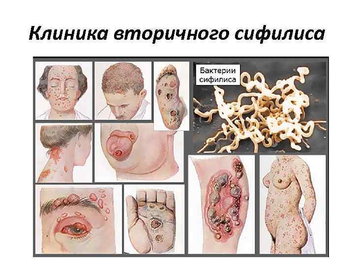 Клиника вторичного сифилиса Клиника вторичного сифилиса