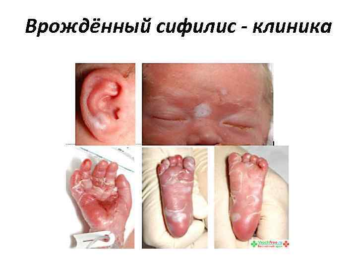 Врождённый сифилис - клиника Врождённый сифилис - клиника