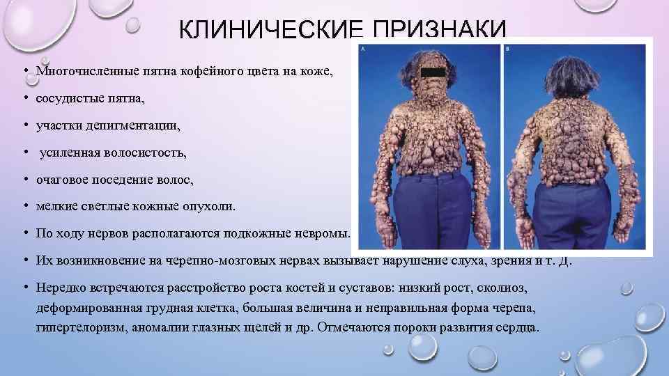     КЛИНИЧЕСКИЕ ПРИЗНАКИ • Многочисленные пятна кофейного цвета на коже, 