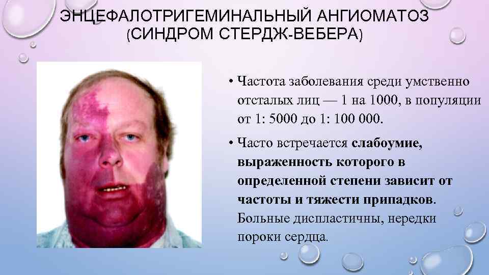 ЭНЦЕФАЛОТРИГЕМИНАЛЬНЫЙ АНГИОМАТОЗ  (СИНДРОМ СТЕРДЖ-ВЕБЕРА)   • Частота заболевания среди умственно  