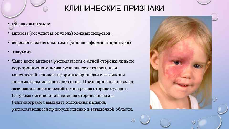      КЛИНИЧЕСКИЕ ПРИЗНАКИ • триада симптомов:  • ангиома (сосудистая