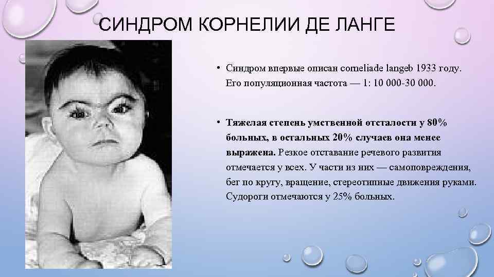 СИНДРОМ КОРНЕЛИИ ДЕ ЛАНГЕ  • Синдром впервые описан corneliade langeb 1933 году. 