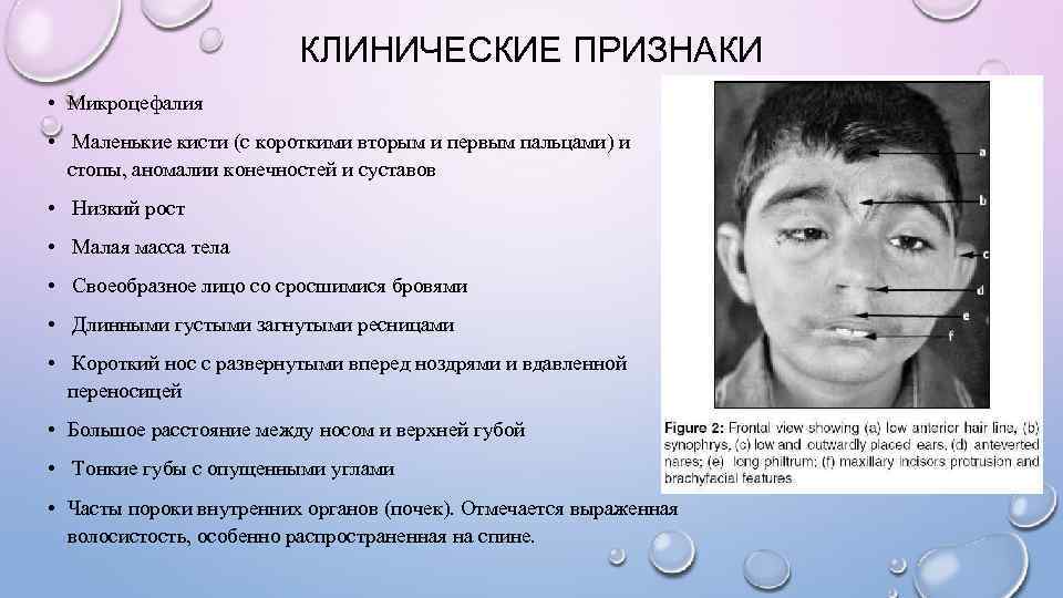      КЛИНИЧЕСКИЕ ПРИЗНАКИ • Микроцефалия • Маленькие кисти (с короткими