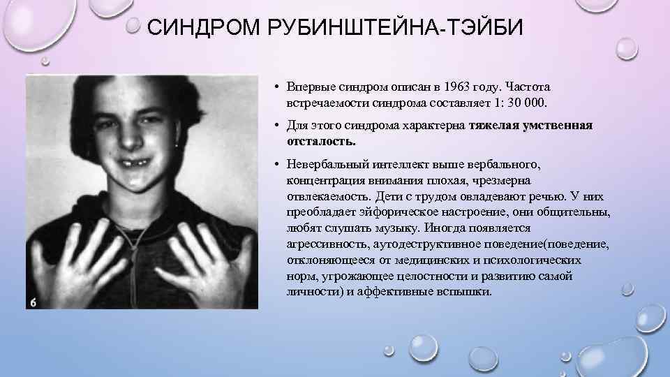 СИНДРОМ РУБИНШТЕЙНА-ТЭЙБИ  • Впервые синдром описан в 1963 году. Частота  встречаемости синдрома