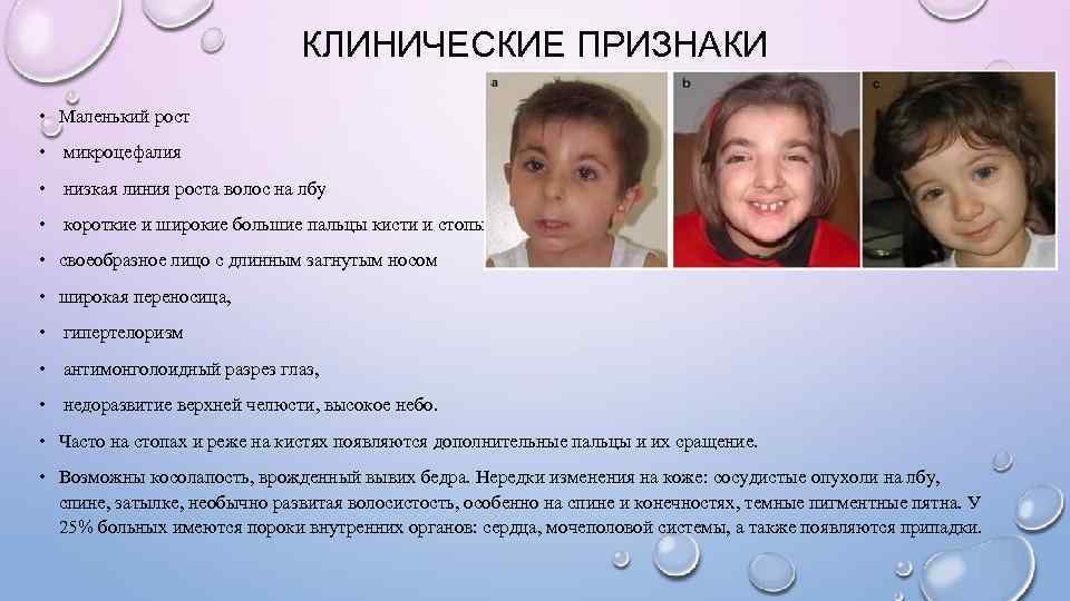      КЛИНИЧЕСКИЕ ПРИЗНАКИ • Маленький рост • микроцефалия • низкая