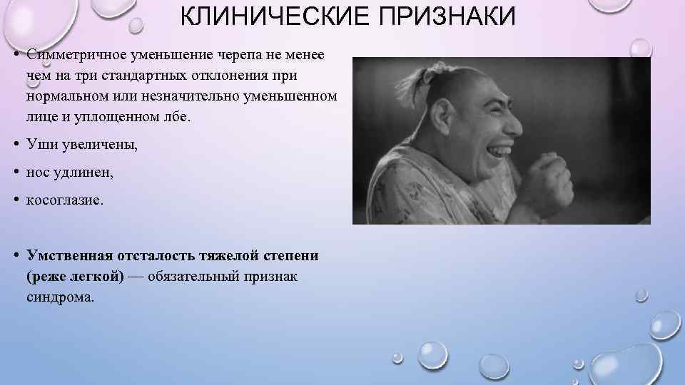      КЛИНИЧЕСКИЕ ПРИЗНАКИ • Симметричное уменьшение черепа не менее 