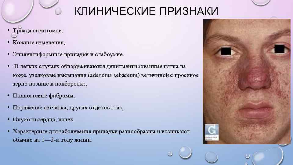     КЛИНИЧЕСКИЕ ПРИЗНАКИ • Триада симптомов:  • Кожные изменения, 