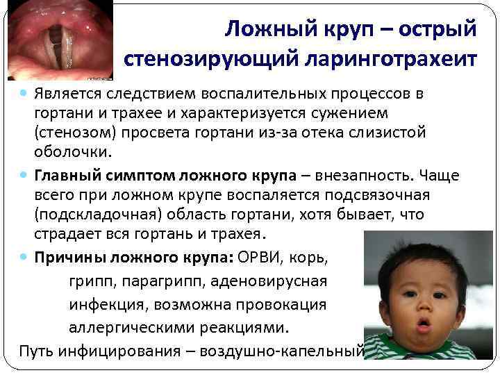     Ложный круп – острый   стенозирующий ларинготрахеит  Является