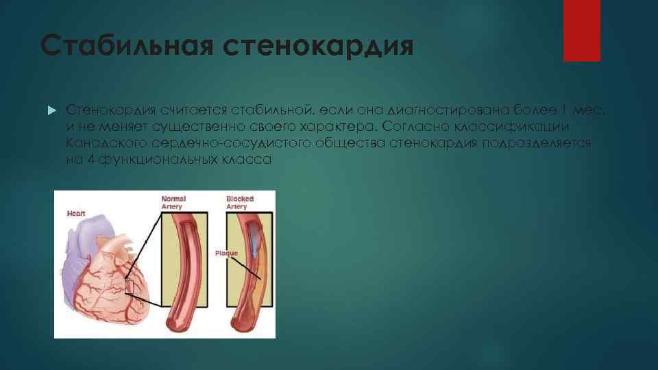 Стабильная стенокардия Стенокардия считается стабильной, если она диагностирована более 1 мес. и не меняет