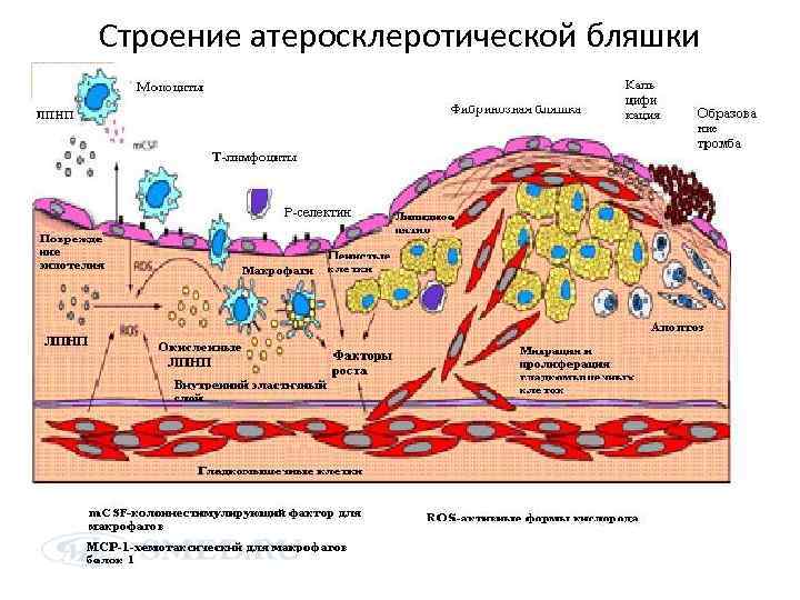 Строение атеросклеротической бляшки 