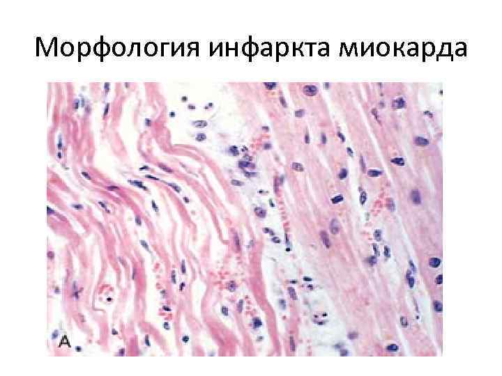 Морфология инфаркта миокарда 
