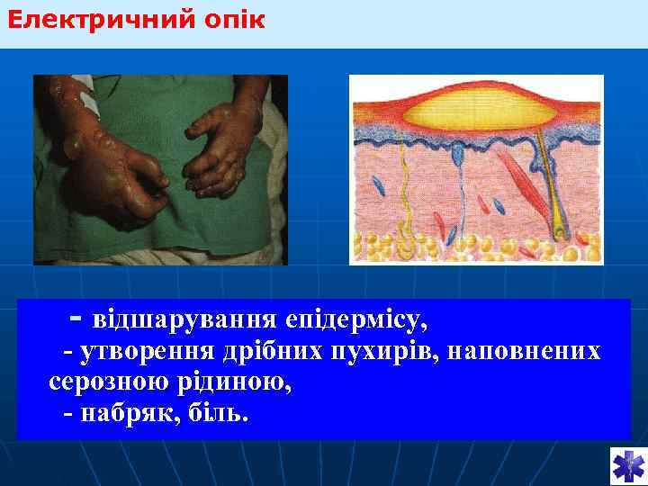 Електричний опік   - відшарування епідермісу, - утворення дрібних пухирів, наповнених  серозною