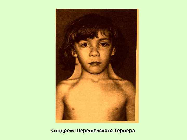 Синдром Шерешевского-Тернера 
