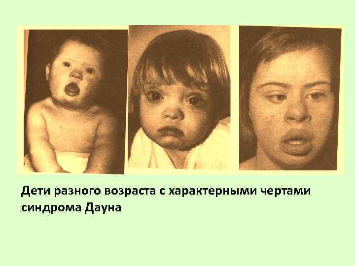 Дети разного возраста с характерными чертами синдрома Дауна 