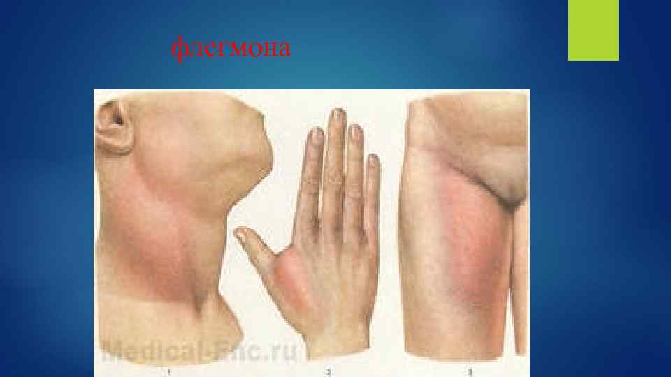 флегмона 