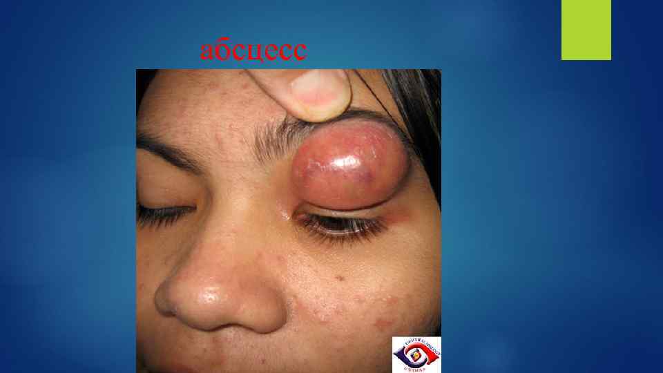 абсцесс 