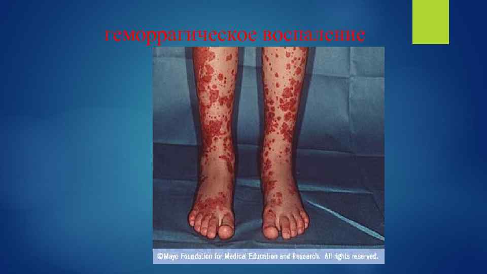 геморрагическое воспаление 