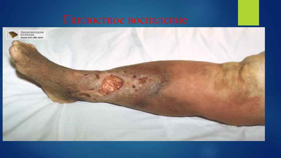 Гнилостное воспаление 