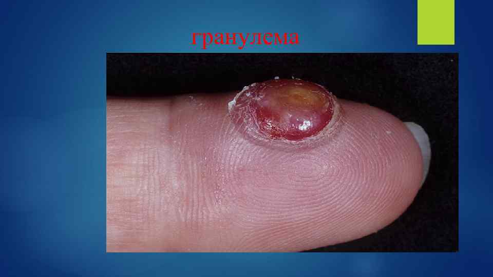 гранулема 