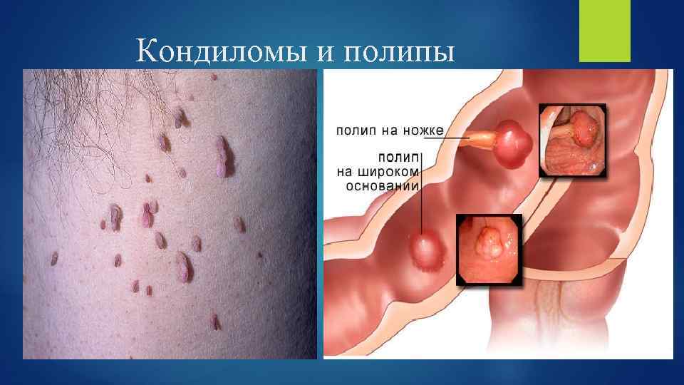 Кондиломы и полипы 