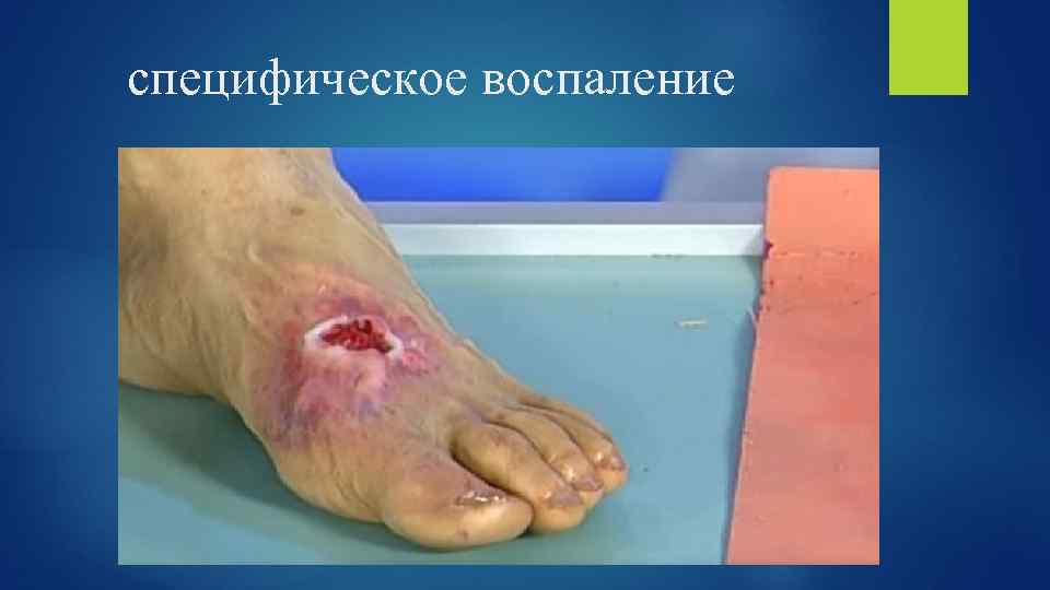 специфическое воспаление 