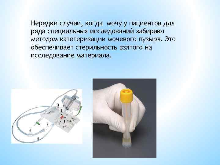 Нередки случаи, когда мочу у пациентов для ряда специальных исследований забирают методом катетеризации мочевого