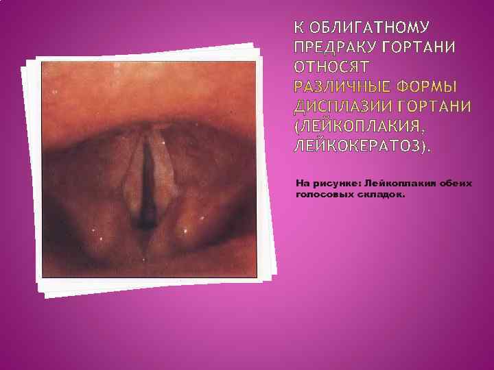 На рисунке: Лейкоплакия обеих голосовых складок. 