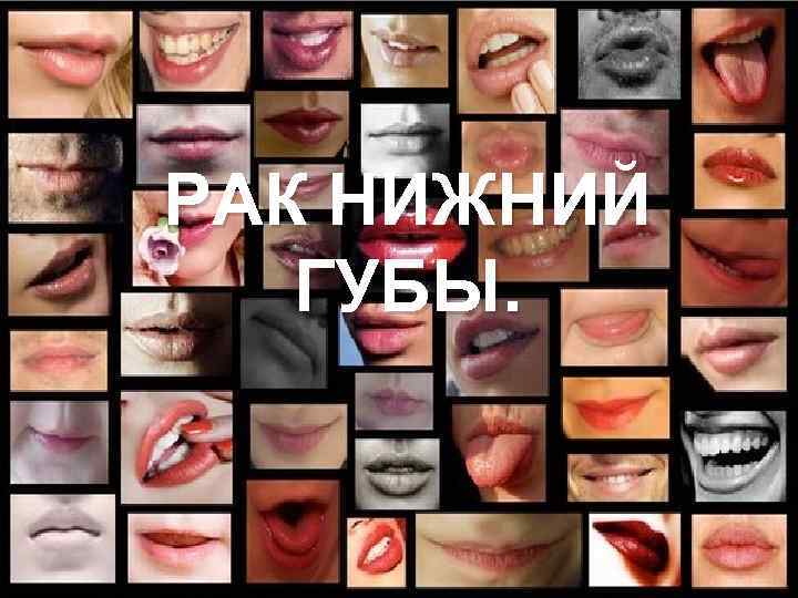 РАК НИЖНИЙ ГУБЫ. 