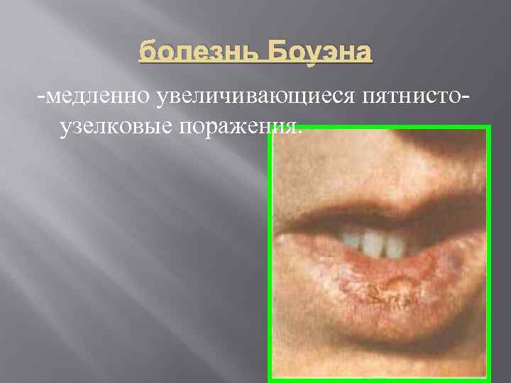   болезнь Боуэна  медленно увеличивающиеся пятнисто  узелковые поражения. 