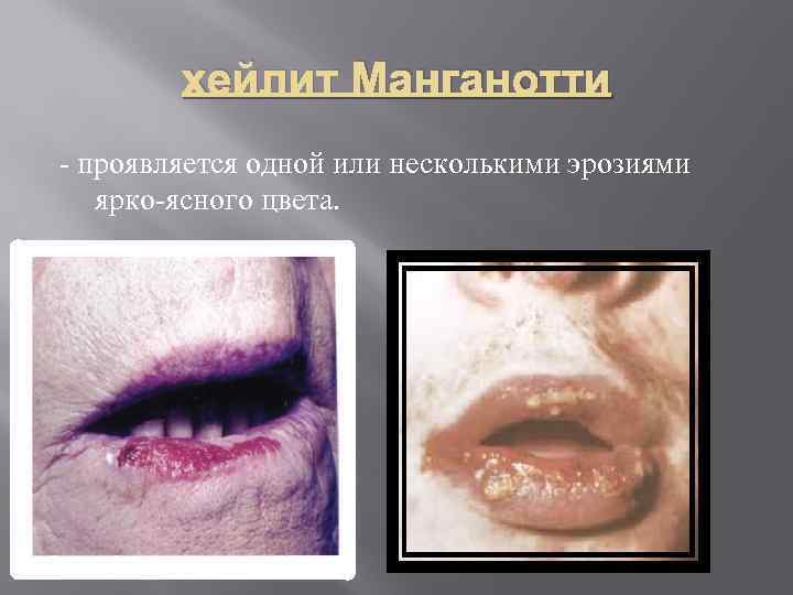   хейлит Манганотти  проявляется одной или несколькими эрозиями ярко ясного цвета. 