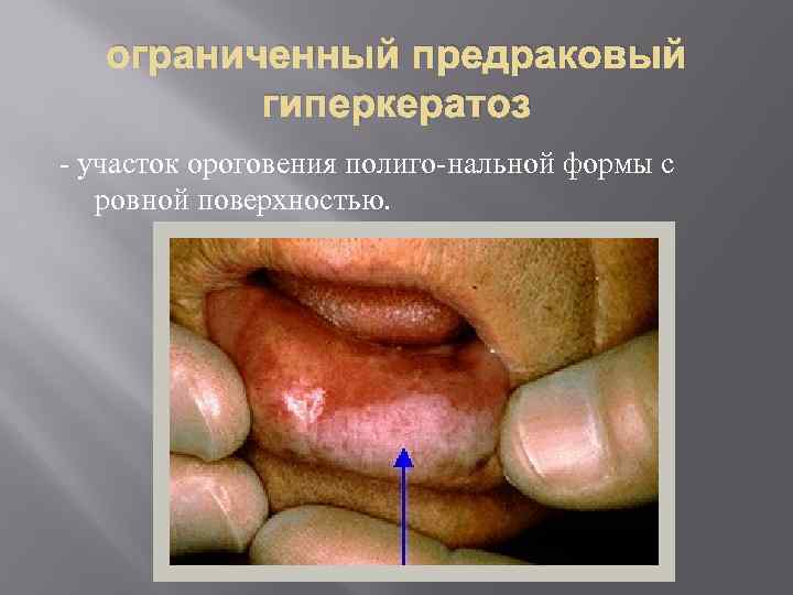   ограниченный предраковый  гиперкератоз  участок ороговения полиго нальной формы с ровной