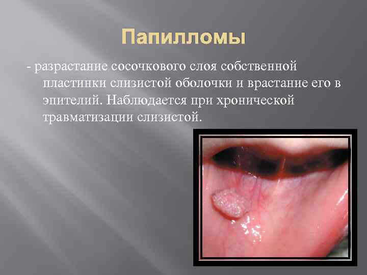     Папилломы  разрастание сосочкового слоя собственной пластинки слизистой оболочки и