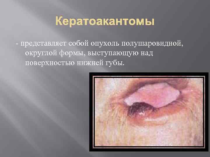    Кератоакантомы  представляет собой опухоль полушаровидной, округлой формы, выступающую над поверхностью