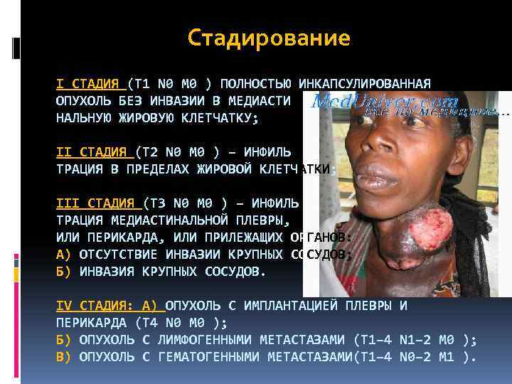     Стадирование I СТАДИЯ (Т 1 N 0 М 0 )