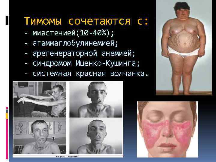 Тимомы сочетаются с: -  миастенией(10 -40%); -  агаммаглобулинемией; -  арегенераторной анемией;