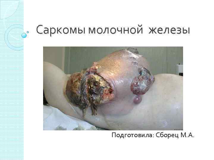 Саркомы молочной железы    Подготовила: Сборец М. А. 
