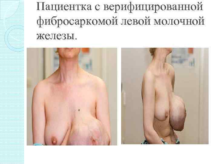 Пациентка с верифицированной фибросаркомой левой молочной железы. 
