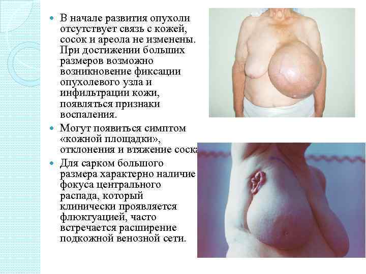  В начале развития опухоли  отсутствует связь с кожей,  сосок и ареола