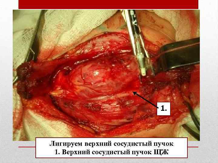      1. Лигируем верхний сосудистый пучок 1. Верхний сосудистый пучок