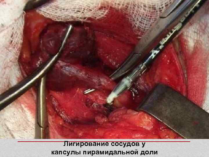   Лигирование сосудов у капсулы пирамидальной доли 