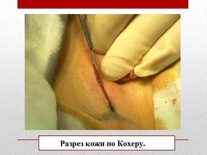 Разрез кожи по Кохеру. 