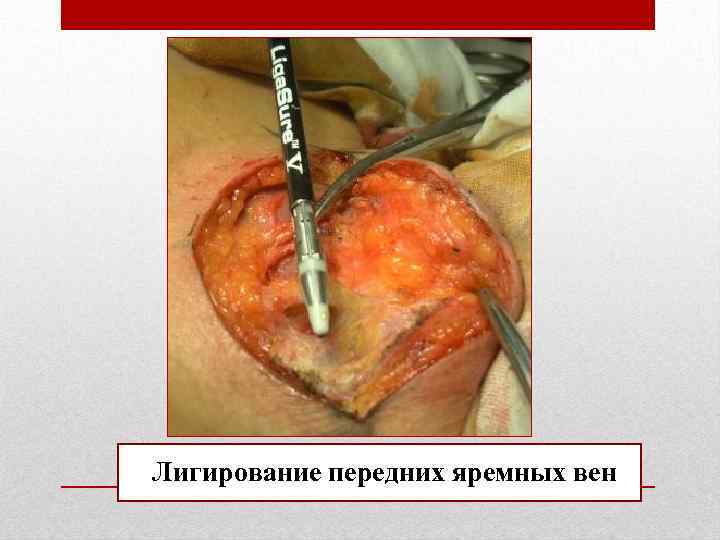 Лигирование передних яремных вен 