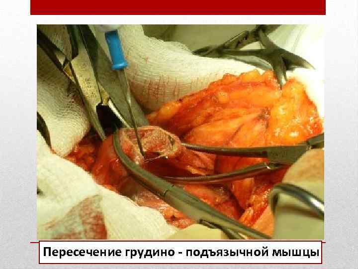 Пересечение грудино - подъязычной мышцы 