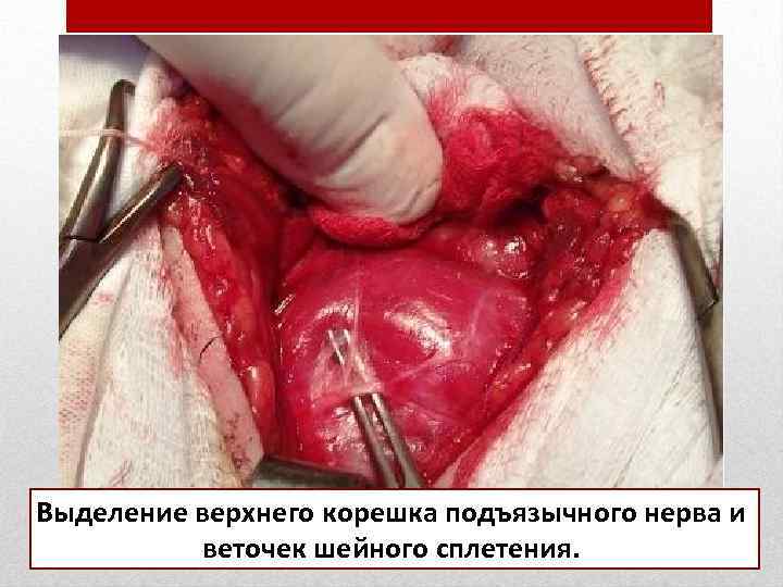 Выделение верхнего корешка подъязычного нерва и  веточек шейного сплетения. 